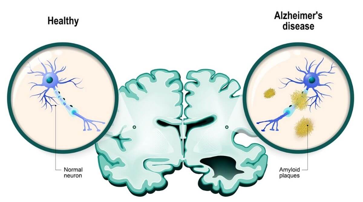 Alzheimer’s Disease – Everything you need to know about it