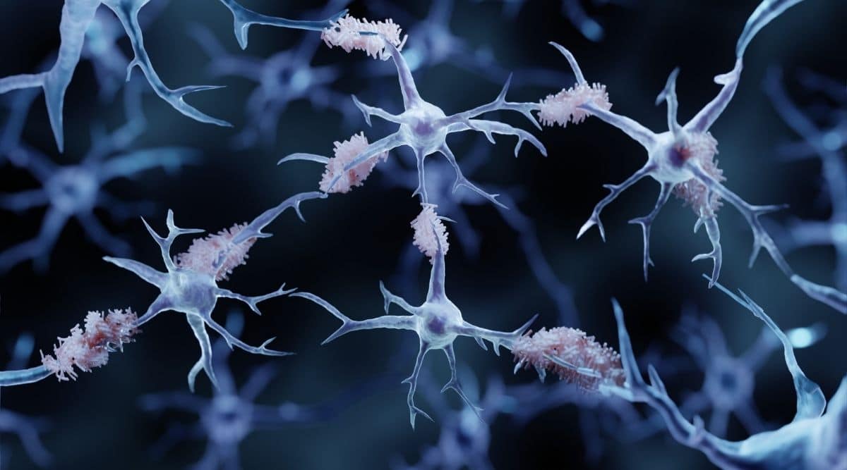 What Role Does Alpha-synuclein Play in Alzheimer’s Disease?